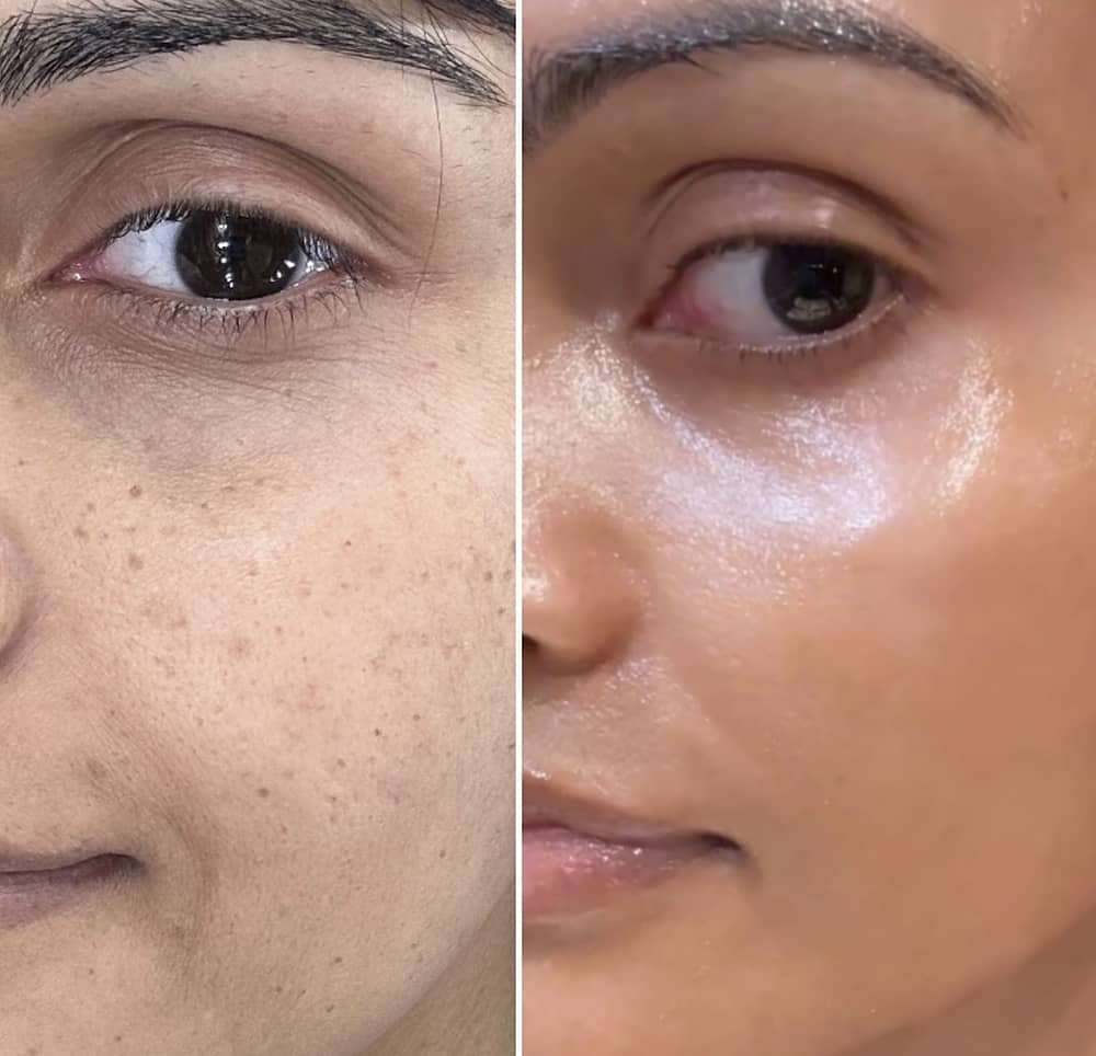 Treatment of hyperpigmentation using the Picosure Pro laser