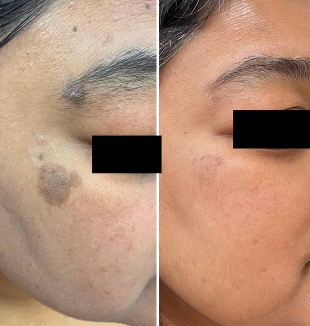 Treatment of hyperpigmentation using the Picosure Pro laser