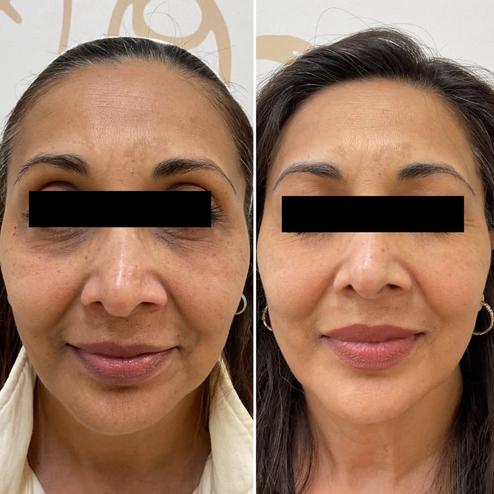 Treatment of hyperpigmentation using the Picosure Pro laser