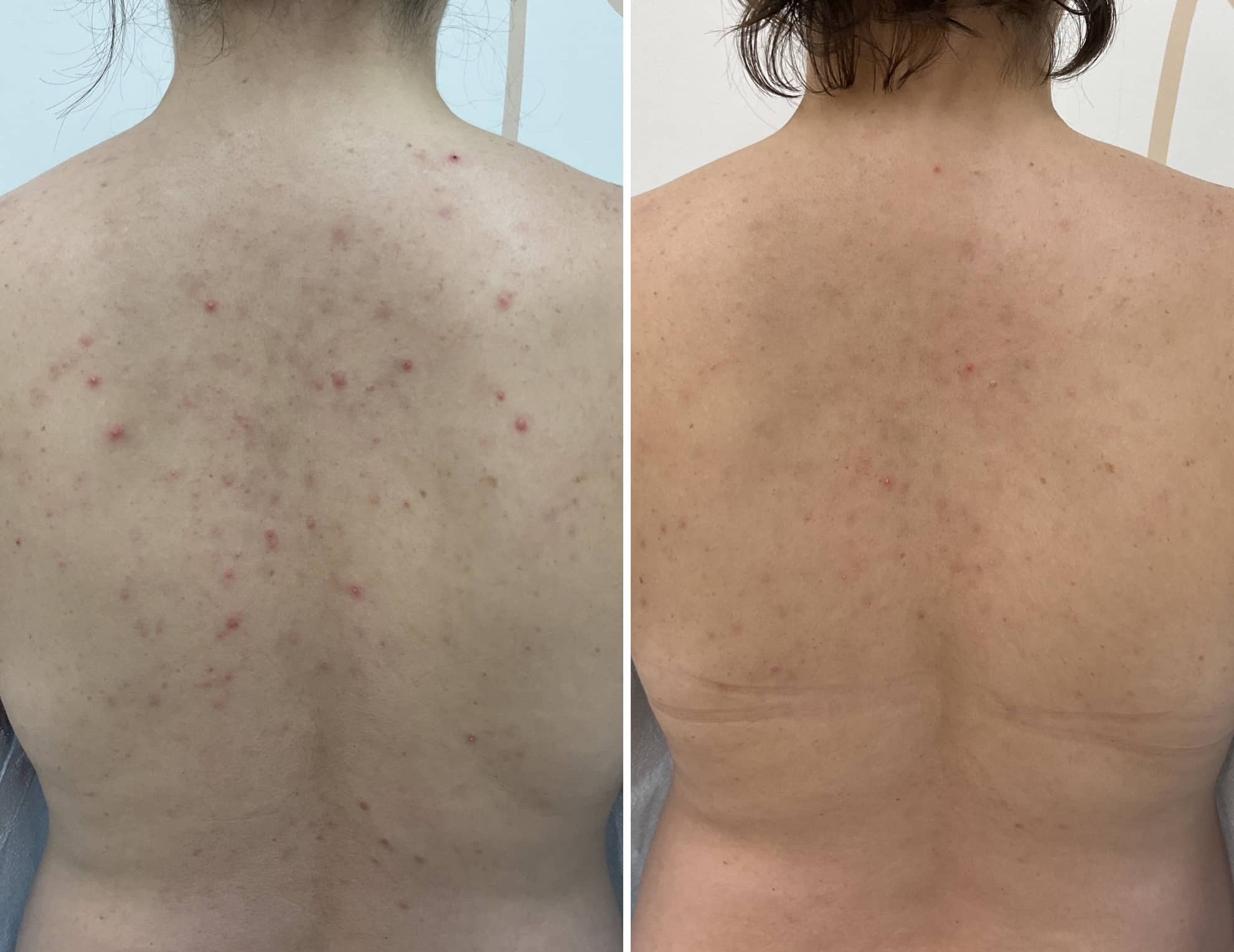 Treatment of acne and dark spots using chemical peels