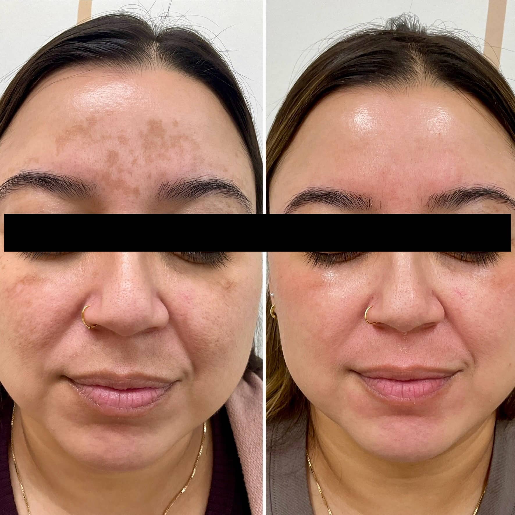 Treatment of melasma