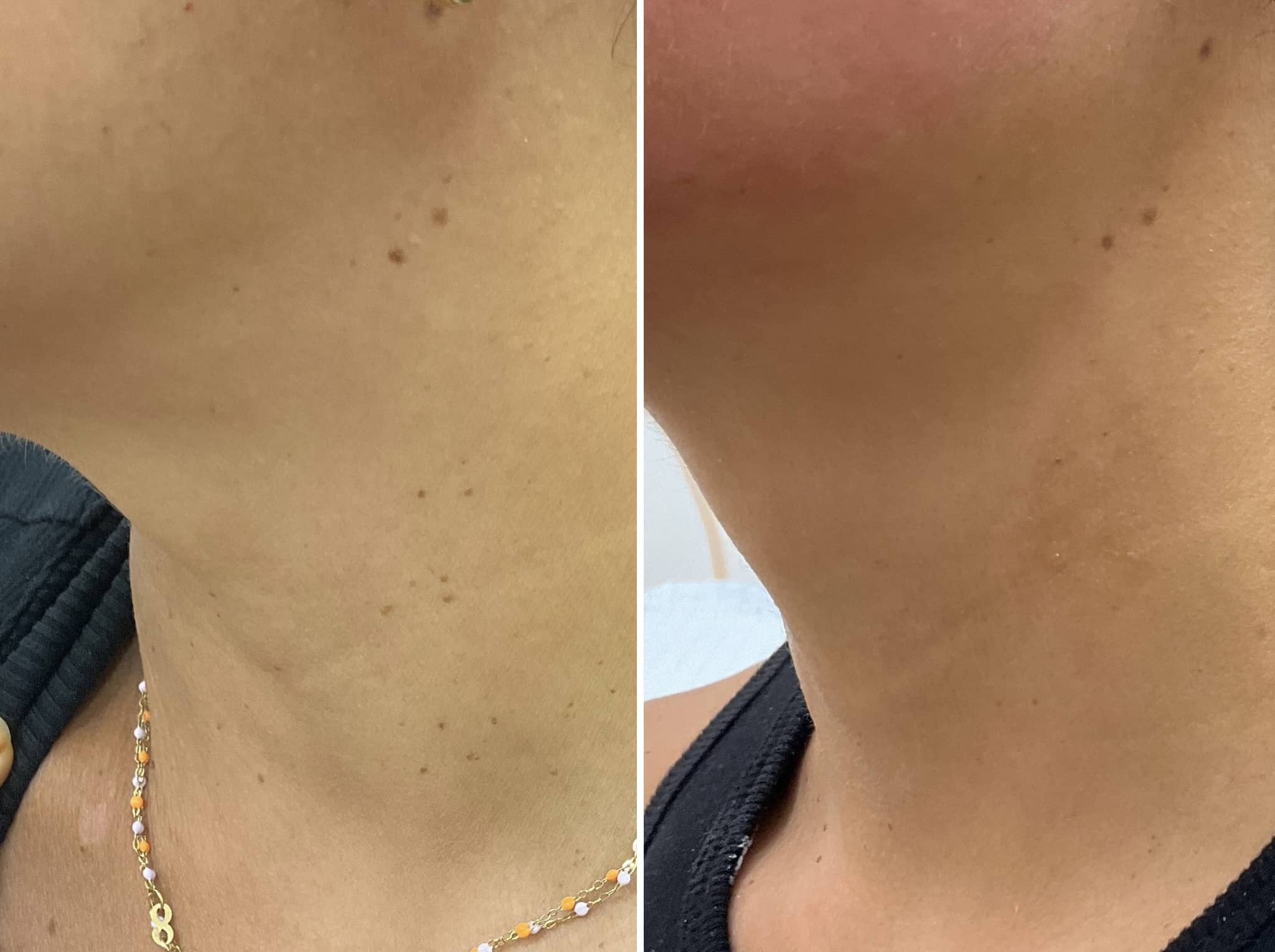 Treatment of brown bumps on the neck