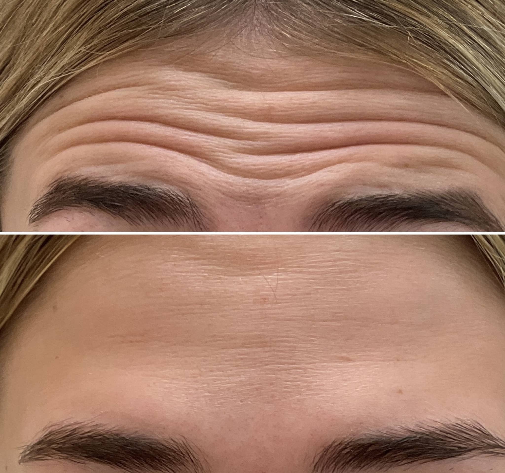 Treatment of wrinkles on the forehead using botulinum toxin